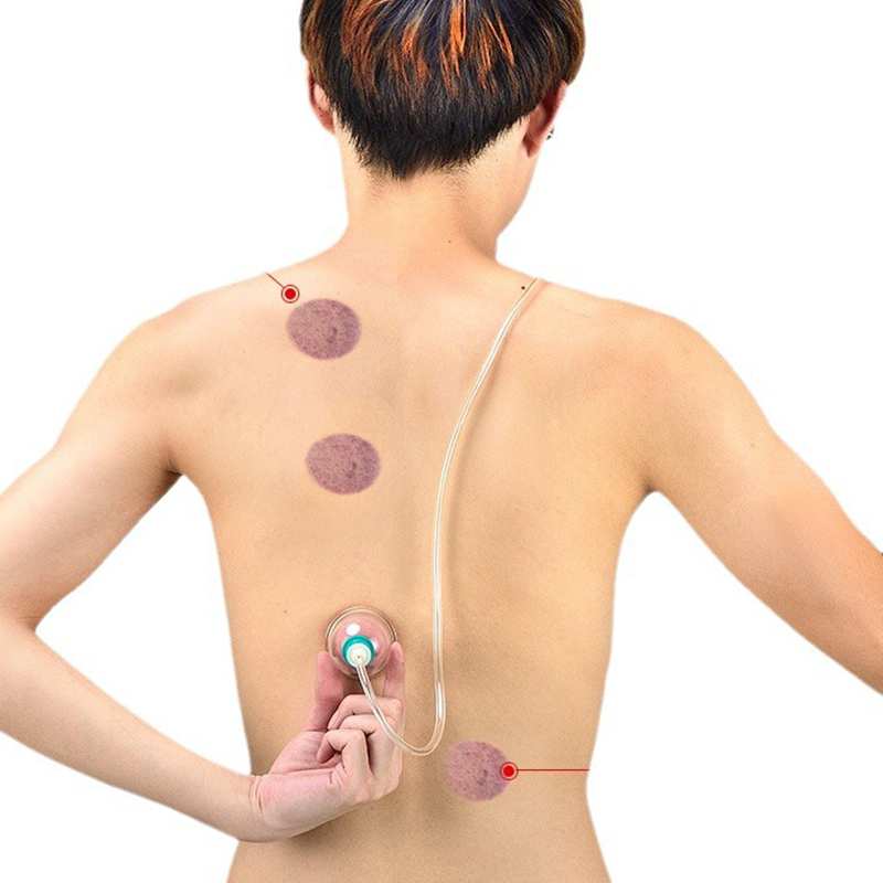 Thickened Vacuum Cupping Set with Suction Pump