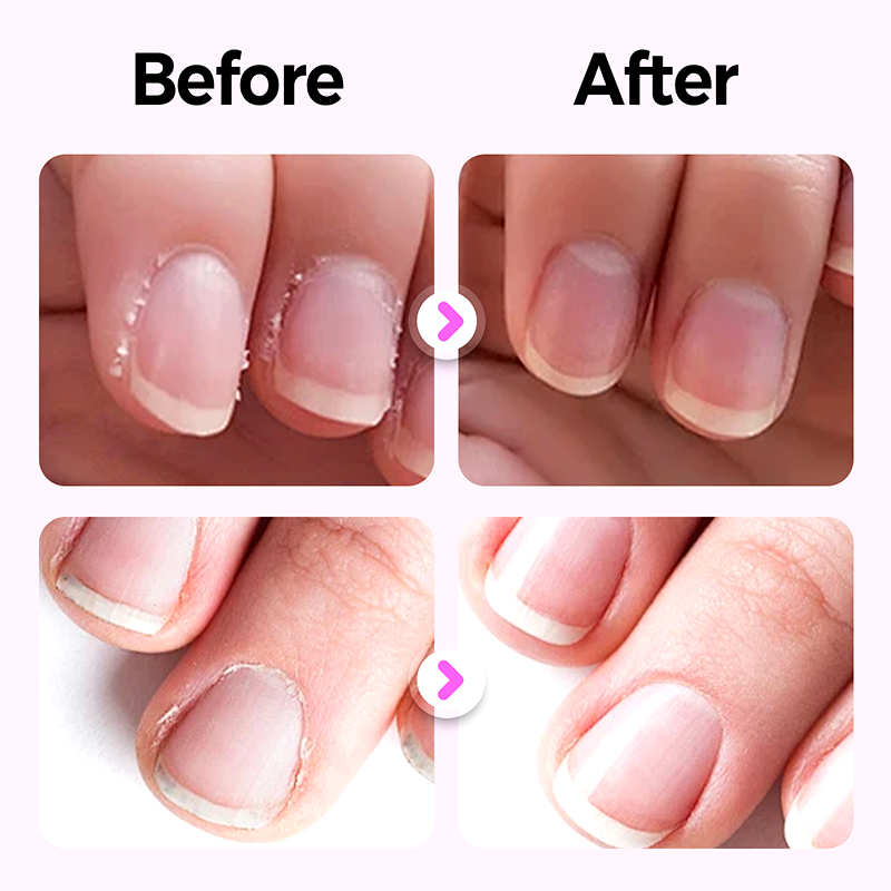 💜Buy 1 Get 1 Free💜2025 New Upgraded 3-in-1 Nail Care Pen